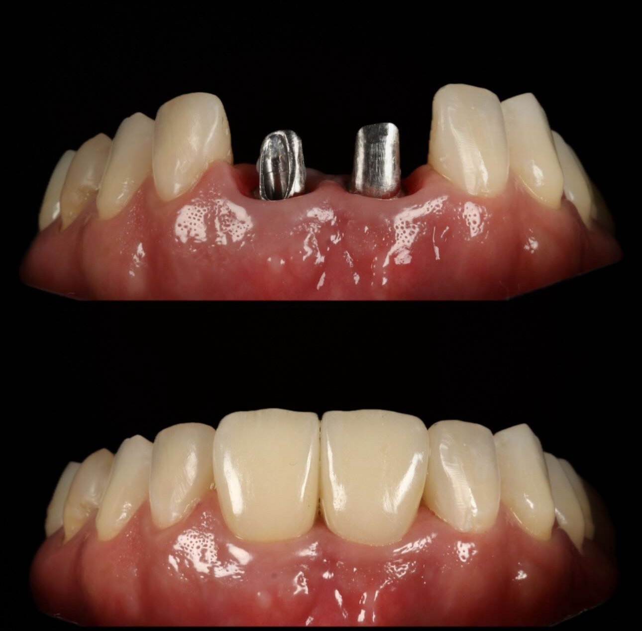 Prótesis sobre implantes - Caso 8